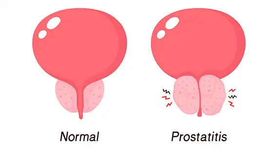 what is enlarged prostate